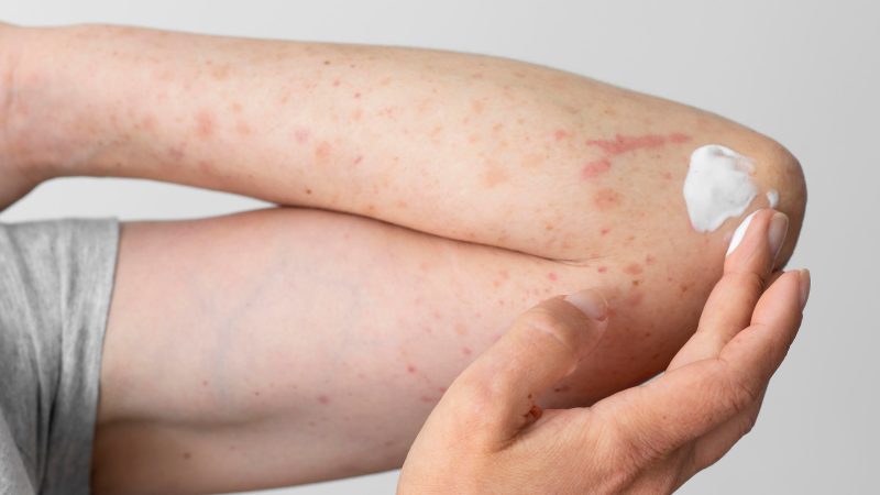 La psoriasis y el verano: cuidados para proteger la piel en época de altas temperaturas