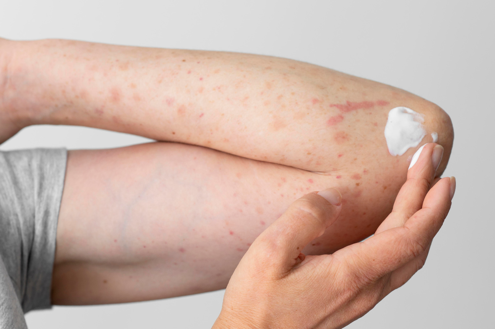 La psoriasis y el verano: cuidados para proteger la piel en época de altas temperaturas