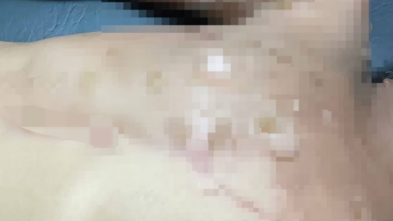 Un hombre habría arrojado comida caliente a su hija de 6 años en Tobatí