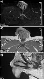 Hombre sufre fractura de pene: Urólogo advierte sobre masturbación y pornografía