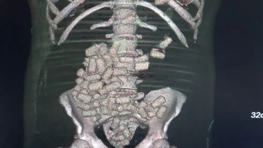 Descubren capsulas en estómago de un hombre que se desvaneció en el Puente de la Amistad