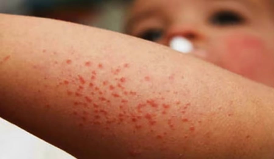 Sarampión en San Pedro: refuerzan vacunación en tres distritos