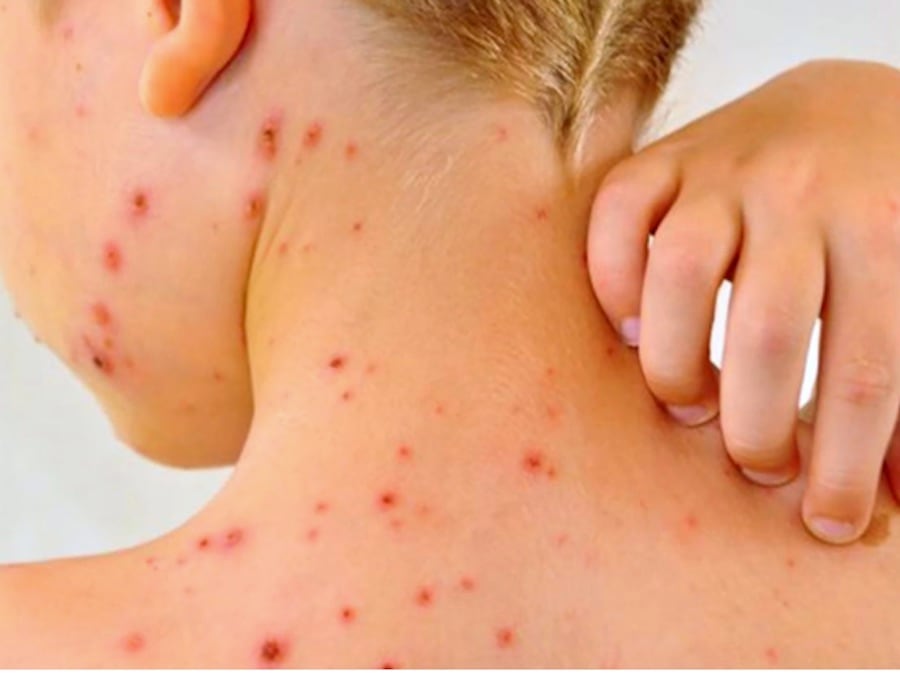 Alerta en Canindeyú: reportan el primer caso sospechoso de sarampión