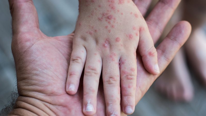 Reaparece el sarampión en Paraguay: activan cerco sanitario en San Pedro