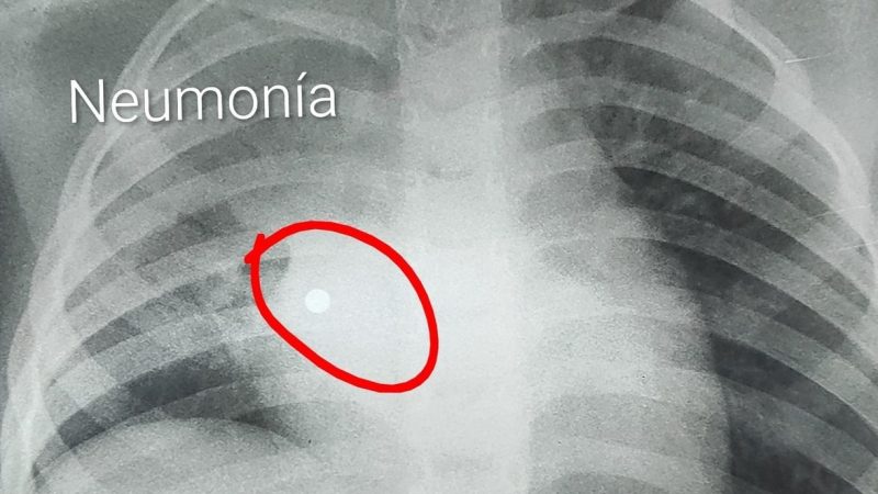 Médicos salvan a niña tras extraer perlita metálica de su pulmón