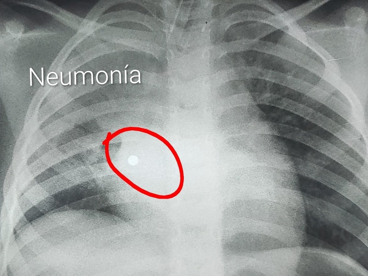 Médicos salvan a niña tras extraer perlita metálica de su pulmón