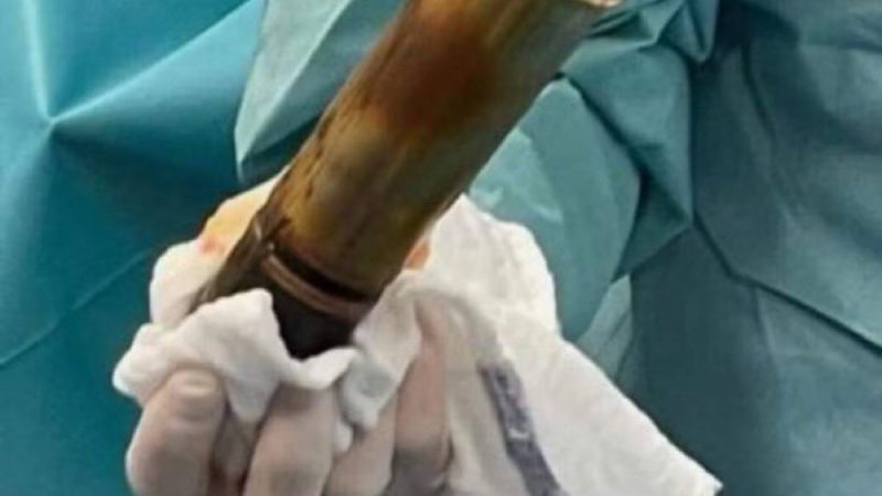 Evacuación rectal: hospital de Francia sacó proyectil de la I Guerra Mundial a un paciente